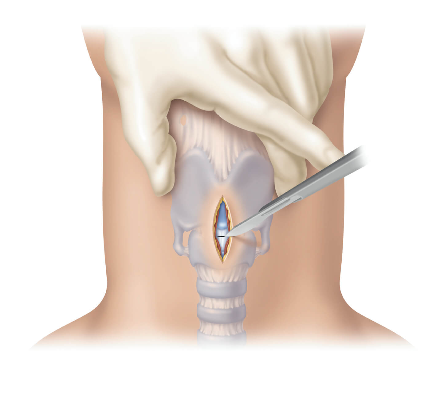Гортань клиника. Трахеостомия операция. Трахеостомия техника проведения. Трахеотомия трахеостомия коникотомия.