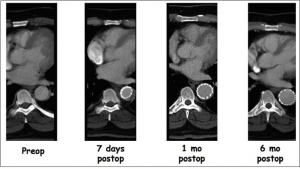type B dissection patient progress from preop to 6 months postop with a composite device design