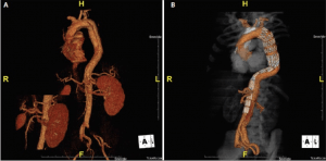 type B aortic dissection CTA