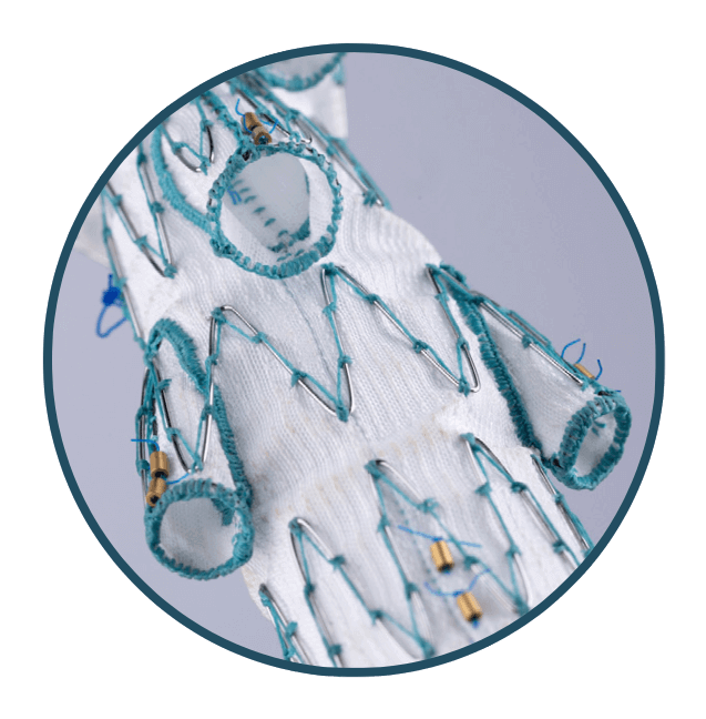 A custom thoracoabdominal device showing internal-external branches.