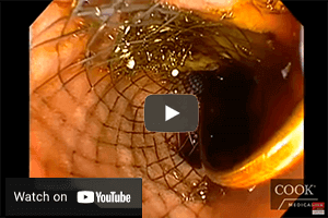 Stricture management videos